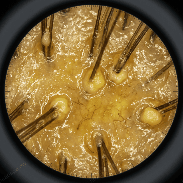 Accelerated Sebum & Scalp Odour - Clinical View
